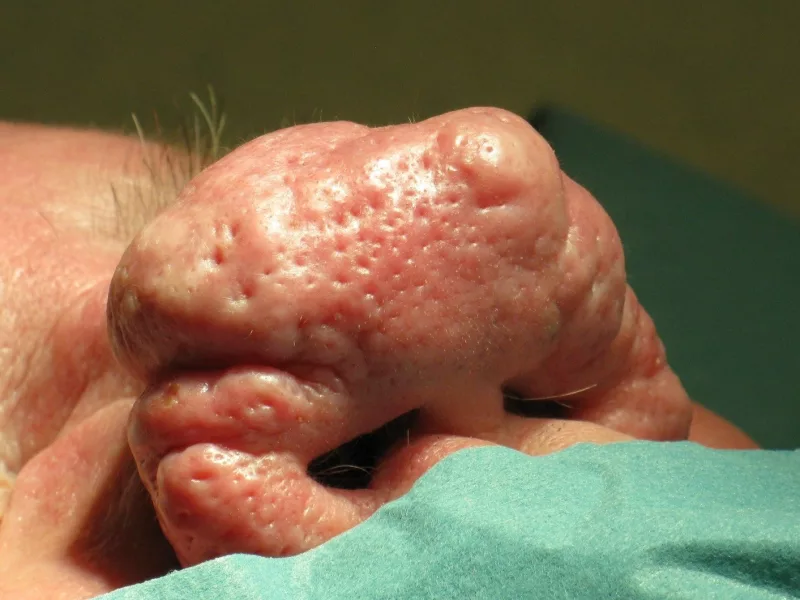 Rhinophyma